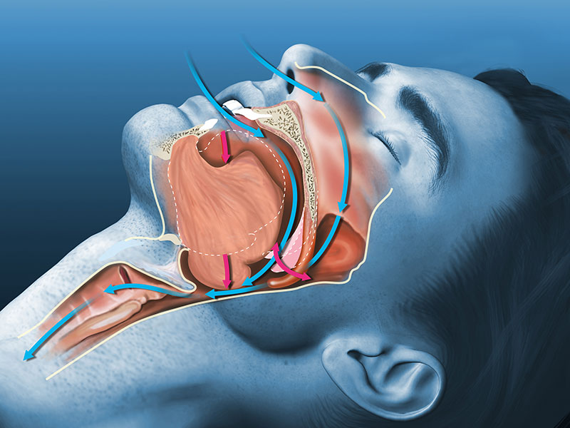 Snoring breathing pathways